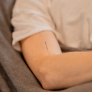 Akupunkturnål i underarm
